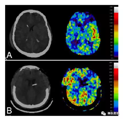 氙气CT定量分析去骨瓣减压后脑血流量变化 脑医汇 神外资讯 神介资讯