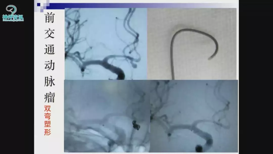 何旭英教授颅内动脉瘤栓塞术中微导管塑形的体会