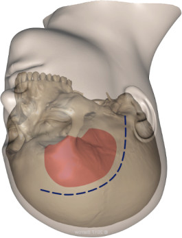 nexus手术技巧丨第三期:改良眶颧入路-内侧型蝶骨嵴脑膜瘤切除术