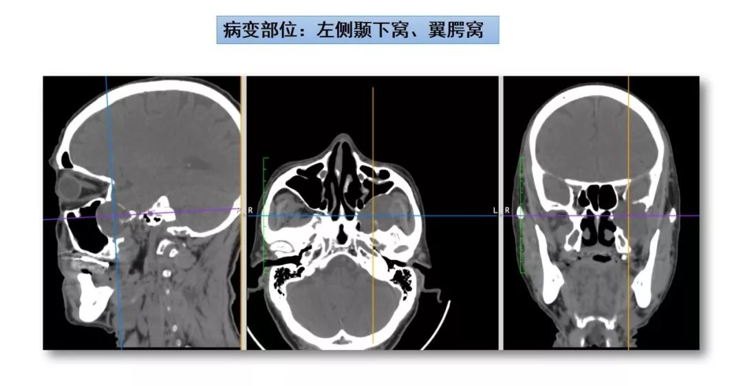 赵天智副教授:"筷子"技术-经鼻泪前隐窝入路切除翼腭窝,颞下窝肿瘤一