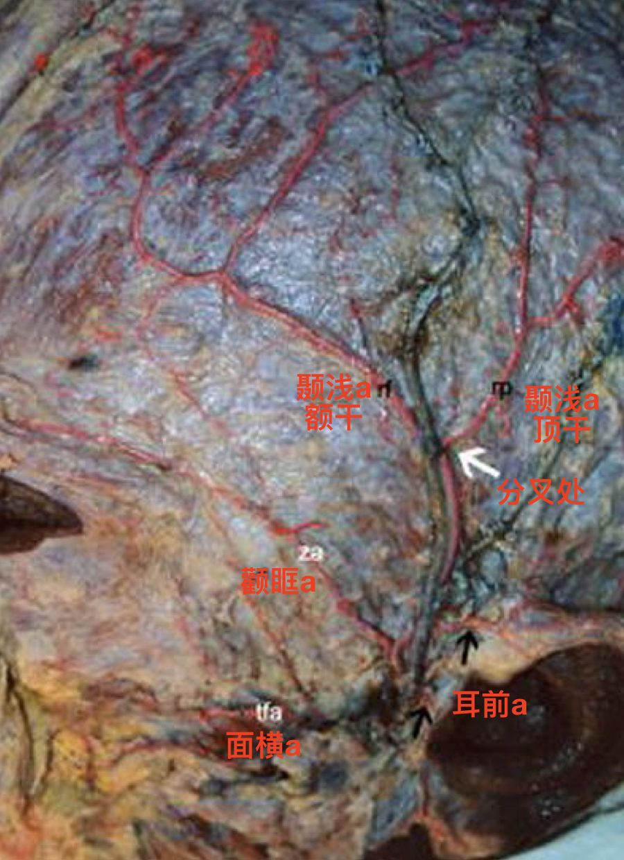 脑血管解剖学习笔记第16期:颞浅动脉大体解剖