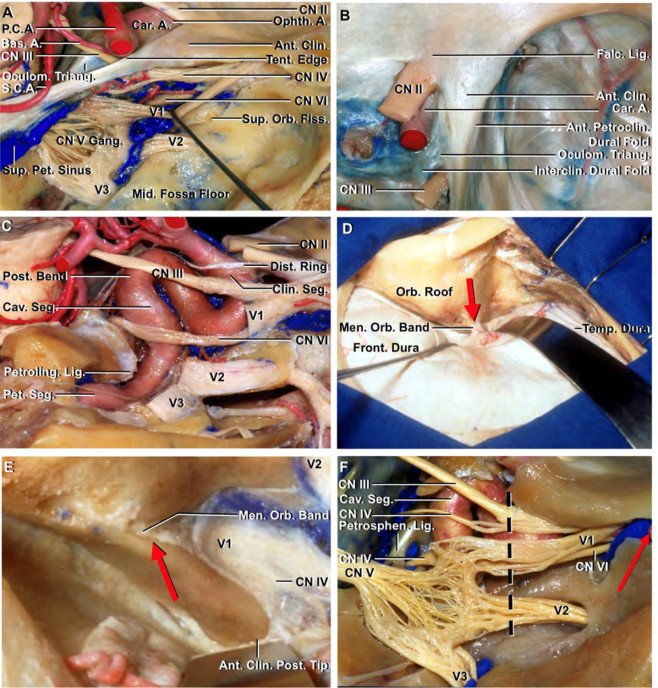视神经管,眶上裂,海绵窦的硬膜,血管和神经的解剖关系.a.