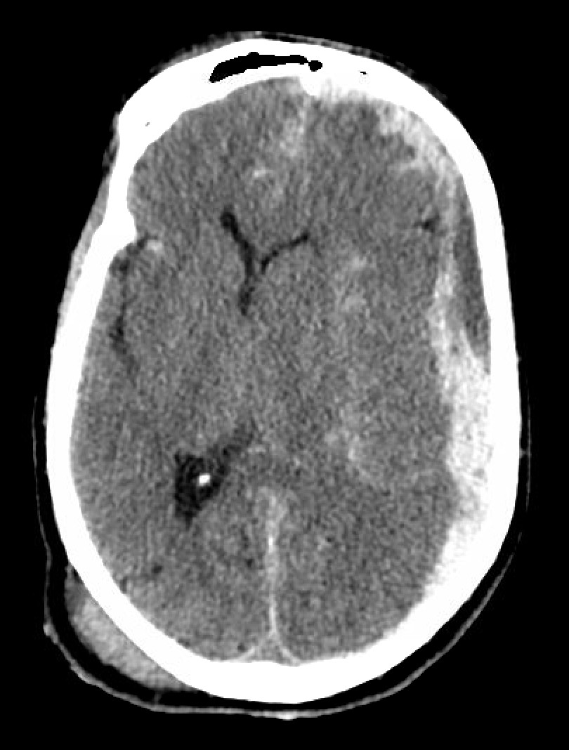 图1. 入院时ct扫描可见左侧额颞顶急性硬膜下出血,中线向右测移位.