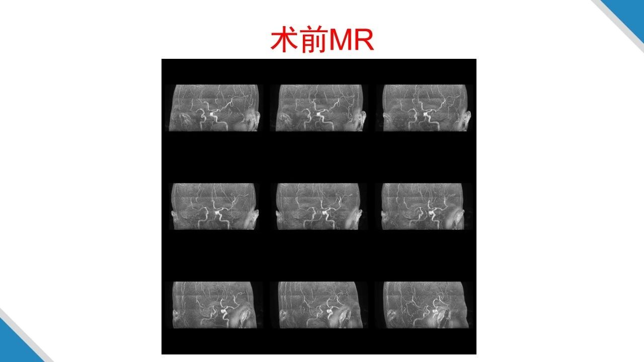 虞正权教授复杂鞍区肿瘤的外科治疗策略