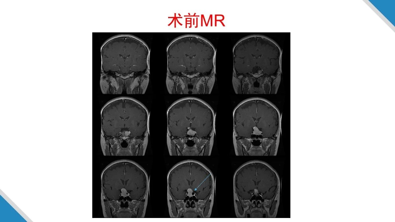 虞正权教授复杂鞍区肿瘤的外科治疗策略