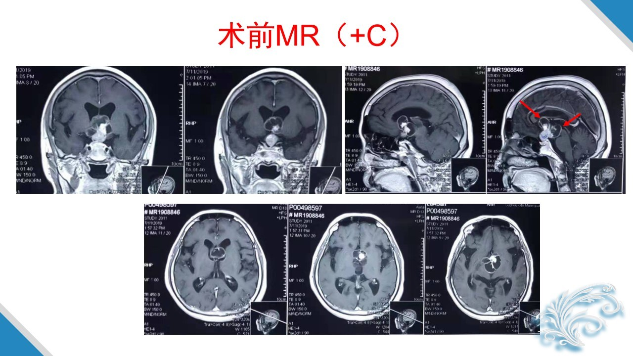 虞正权教授复杂鞍区肿瘤的外科治疗策略