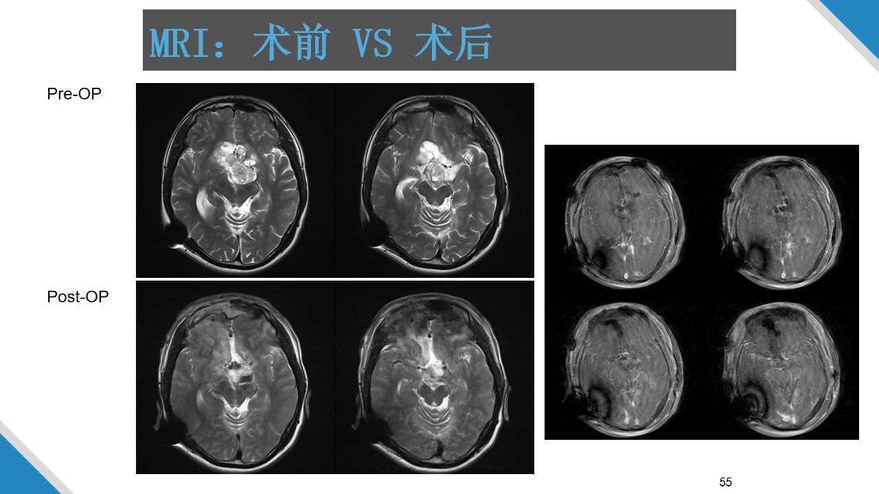 虞正权教授复杂鞍区肿瘤的外科治疗策略