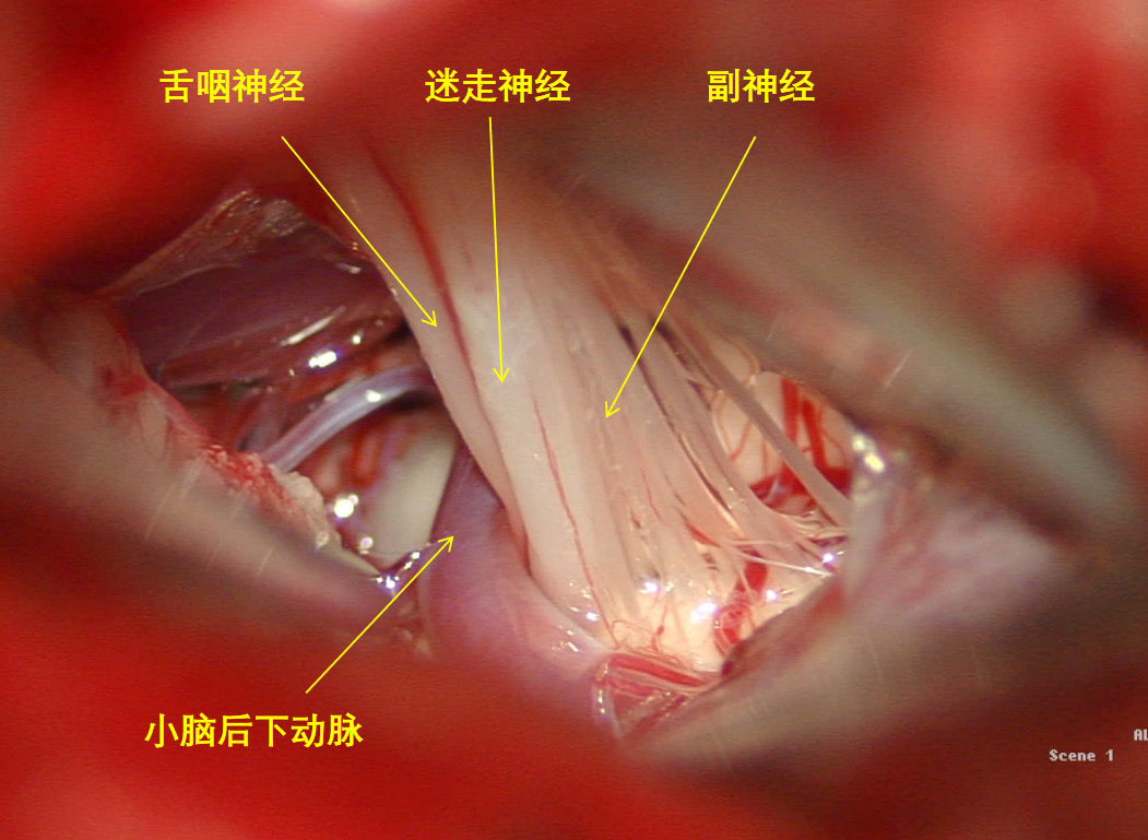 正文 病例三:舌咽神经痛 右侧乙状窦后入路舌咽神经微血管减压术 患者