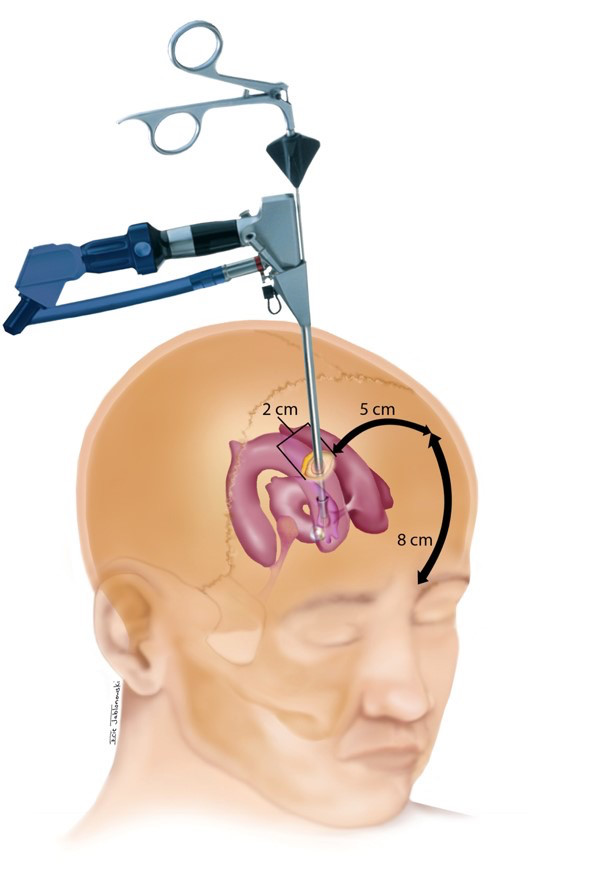 nexus手术技巧丨第四十八期:神经内镜下切除三脑室胶样囊肿一例