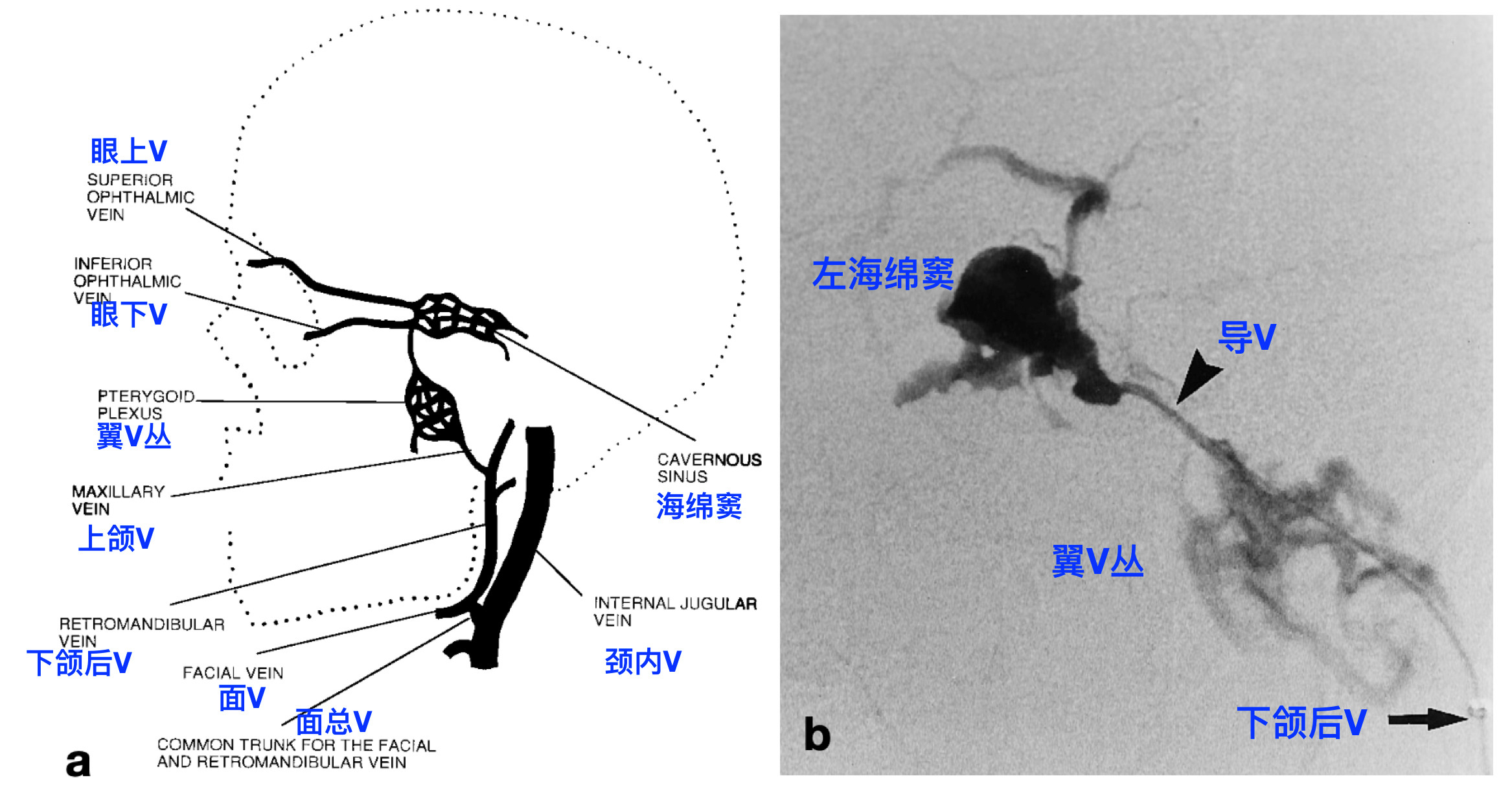 脑血管解剖学习笔记第26期翼静脉丛大体解剖