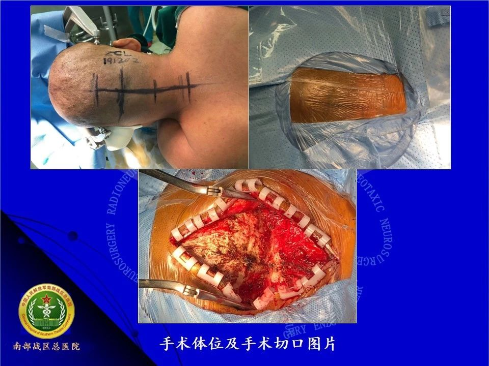 王国良教授团队:一次开颅切除后颅窝六个血管母细胞瘤