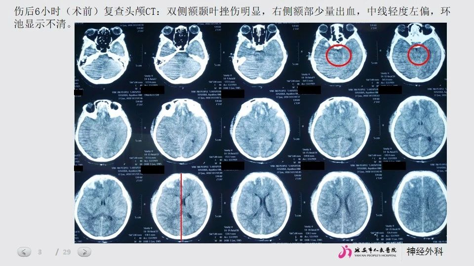 一例特重型颅脑损伤患者治疗探讨颅脑创伤神经重症周刊第157期