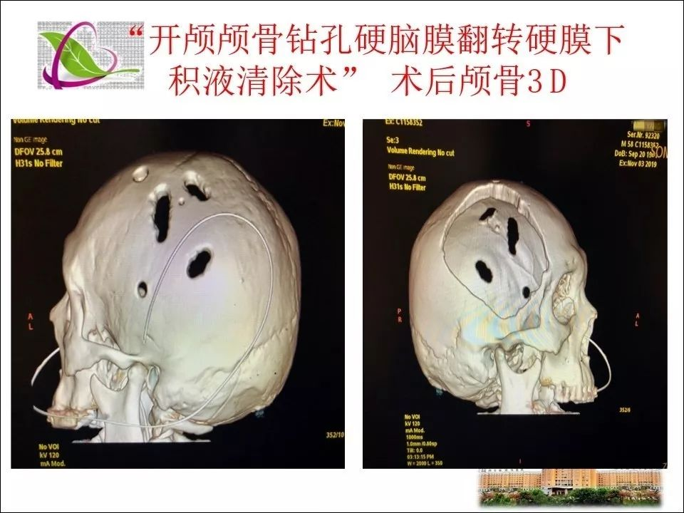 重型颅脑外伤去骨瓣减压术后并发对侧进展型难治性硬膜下积液处理及