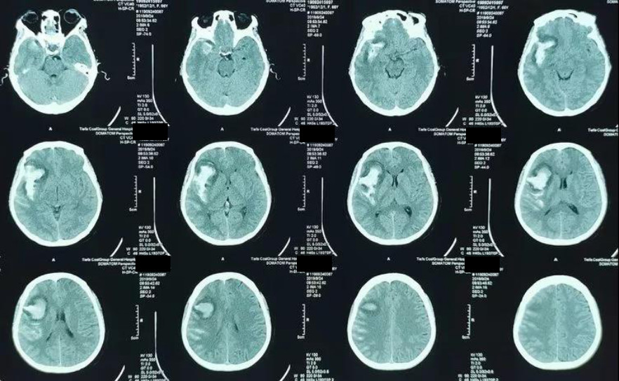 ct提示sah,右侧外侧裂池内有血肿,周围有脑水肿影像学改变.