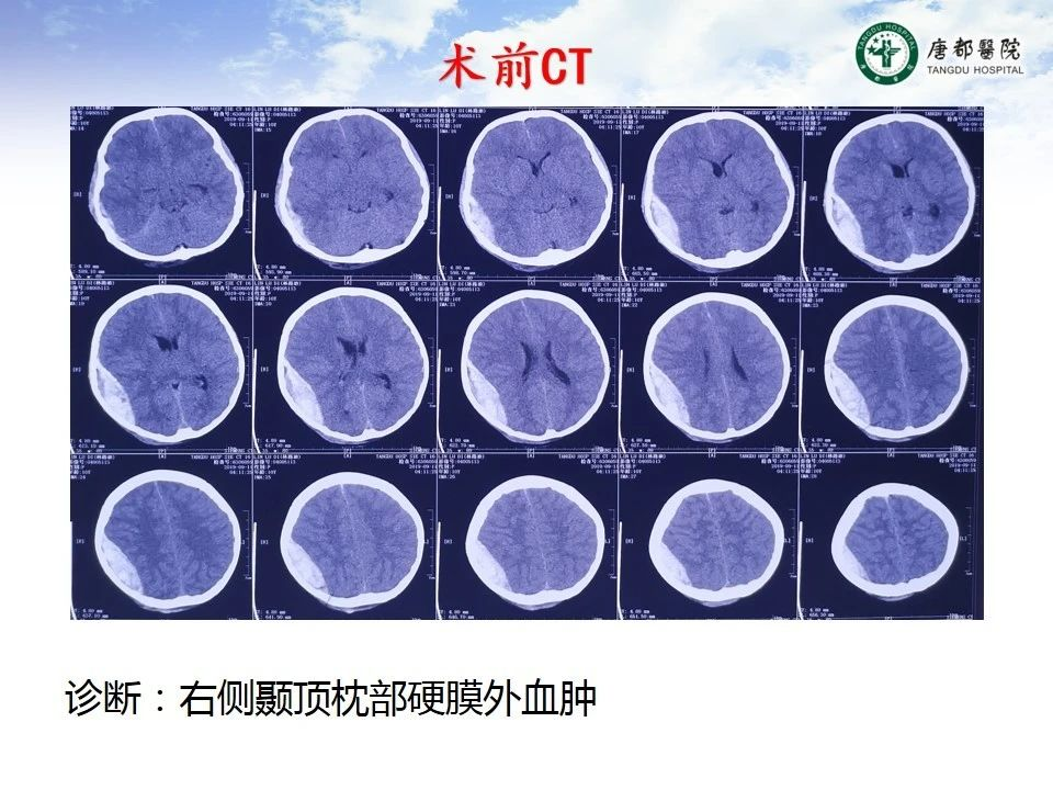 一例小儿急性硬膜外血肿伴术中急性脑膨出病例讨论--【颅脑创伤-神经