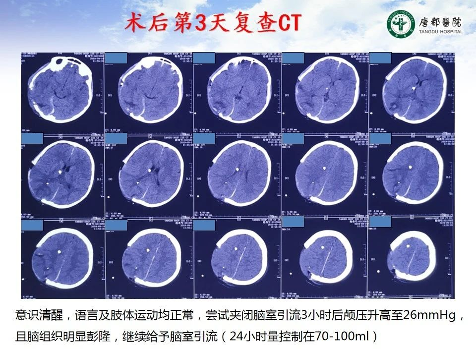 一例小儿急性硬膜外血肿伴术中急性脑膨出病例讨论--【颅脑创伤-神经