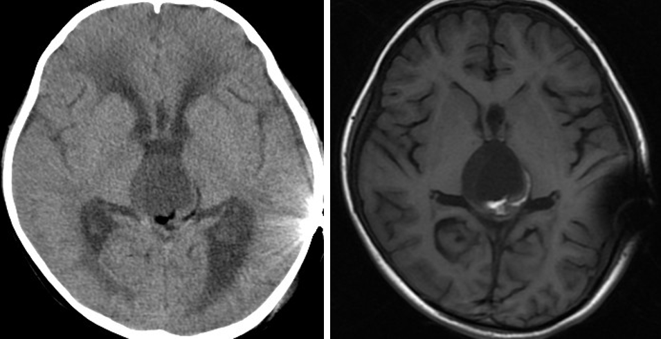 外院ct提示松果体区占位,梗阻性脑积水,遂急诊行脑室腹腔分流术