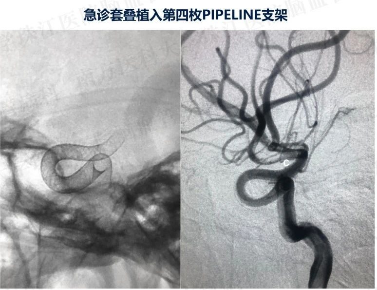 急诊套叠植入第四枚pipeline支架后瘤颈喷射征消失