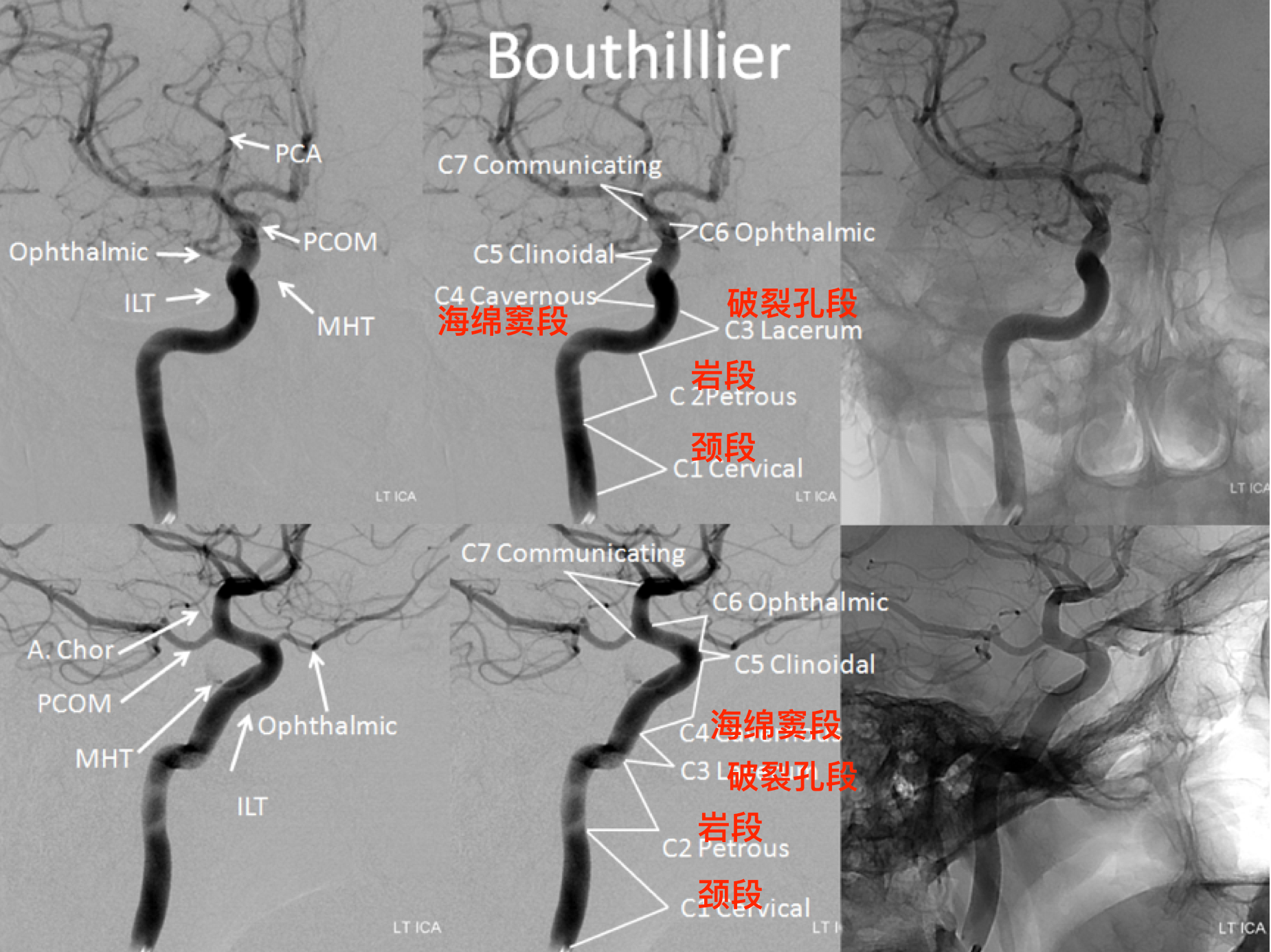 是bouthillier等(bouthillier 1996)于1996年提出的颈内动脉分段方法