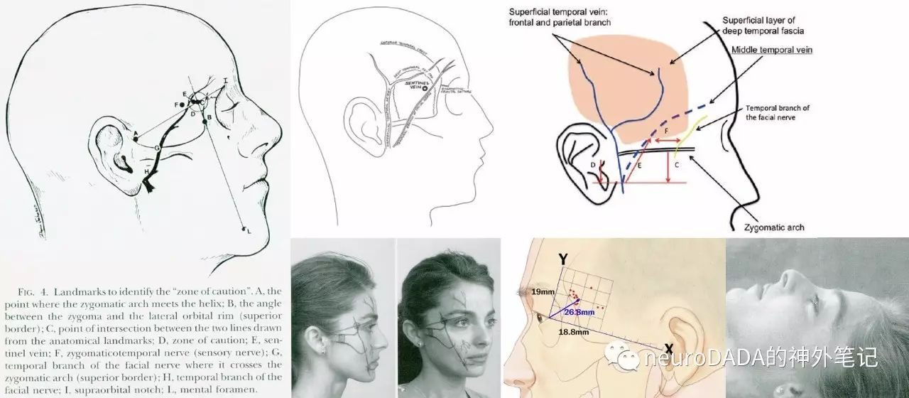 解剖小细节——颧颞静脉和神经