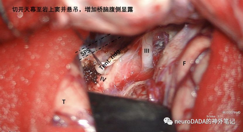 腹侧桥脑手术入路的思考