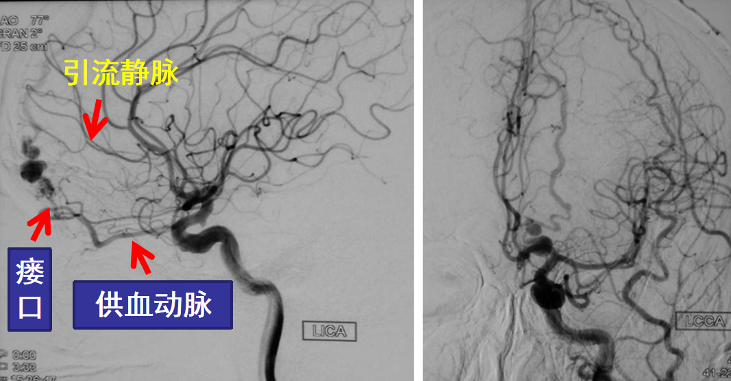 dsa:硬脑膜动静脉瘘