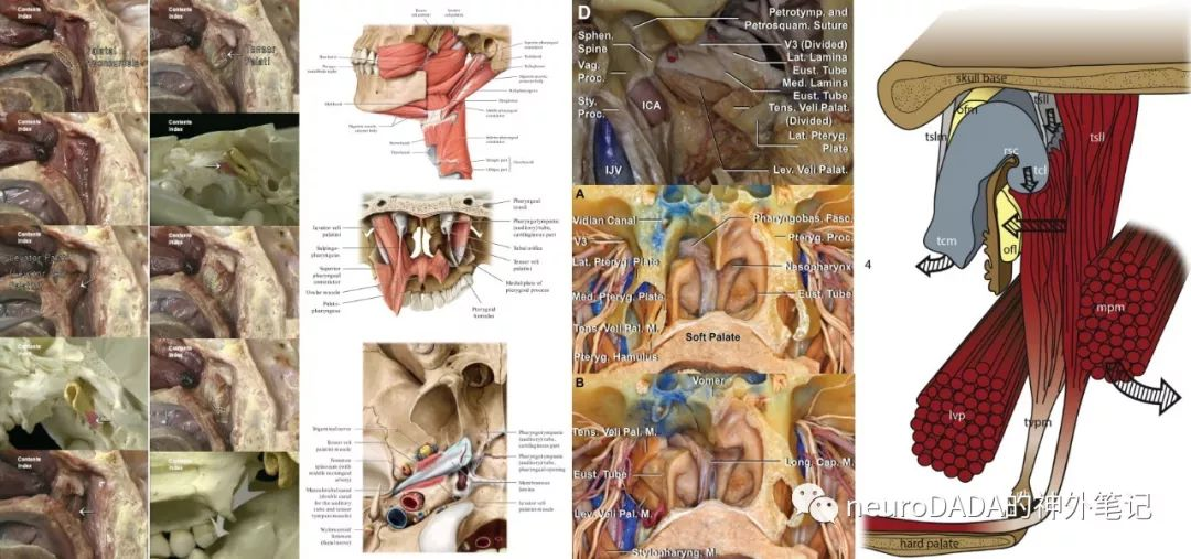 veli palatini muscle,tvpm)起自蝶骨棘(sphenoid spine),舟状窝