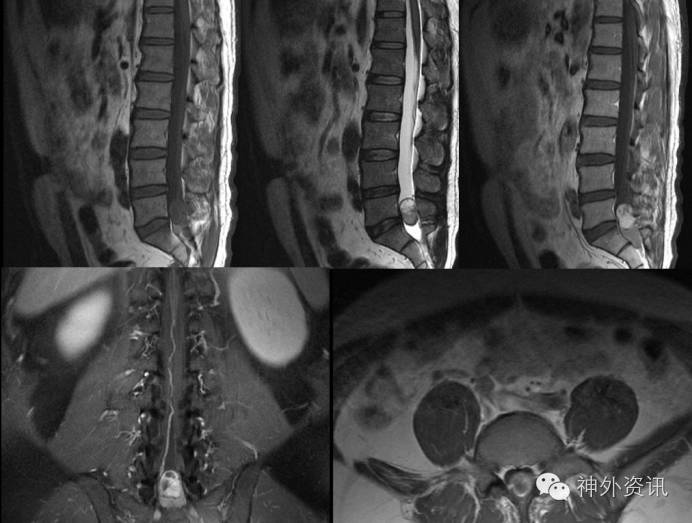 腰椎mri检查提示腰5/骶1椎管内占位,考虑神经鞘瘤可能,椎管内少量积