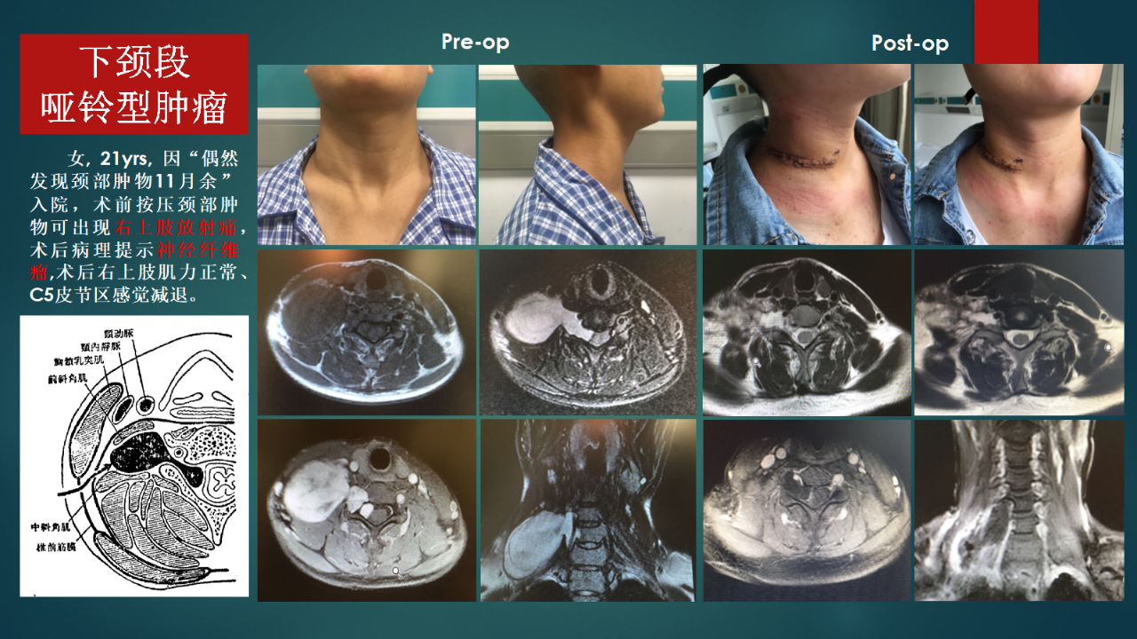 (2)血管结构,从侧方胸锁乳突肌后方显露肿瘤时,颈鞘位于胸锁乳突肌腹