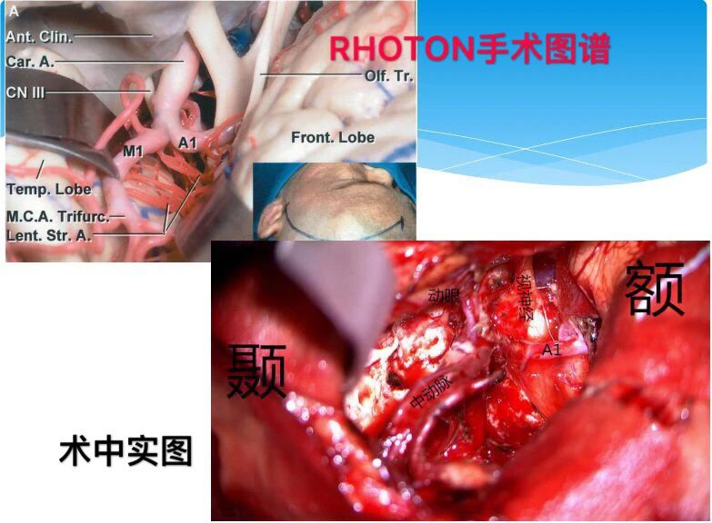 岛叶胶质瘤治疗手术视频