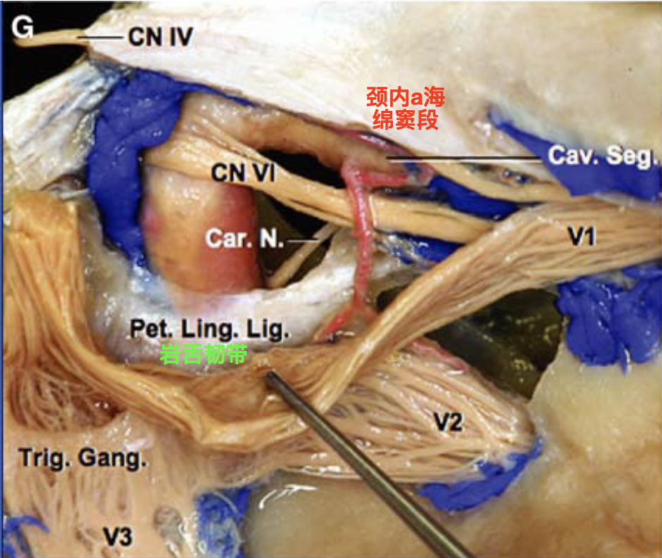 脑血管解剖学习笔记第35期:颈内动脉海绵窦段解剖