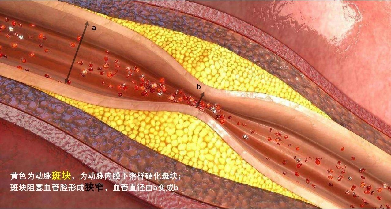 颈动脉狭窄和颈动脉斑块,你分清楚了吗?