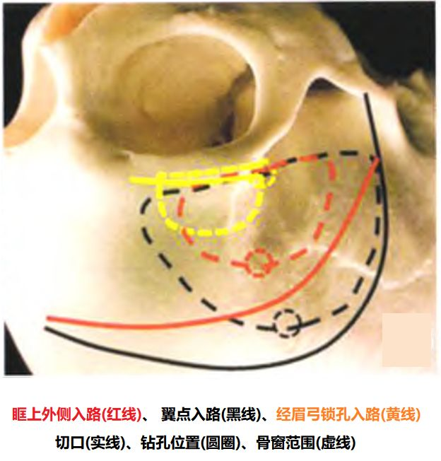 眶上外侧入路---我的手术学习笔记系列