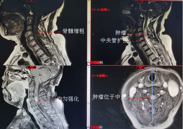c45椎体水平髓内室管膜瘤并脊髓中央管扩张手术病例分享