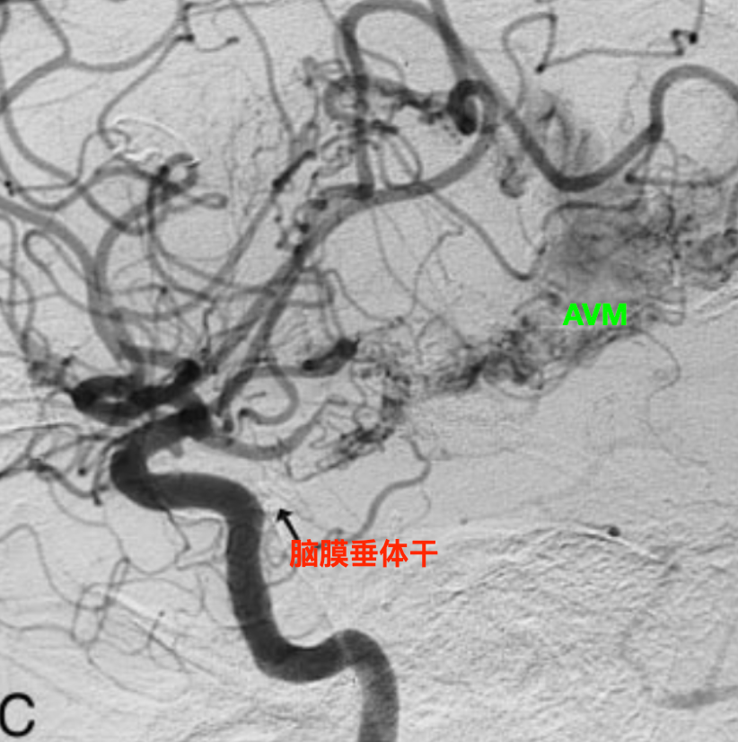 左图,颈内动脉造影,侧位;实箭为小脑幕动脉,箭头为脉络膜前动脉.