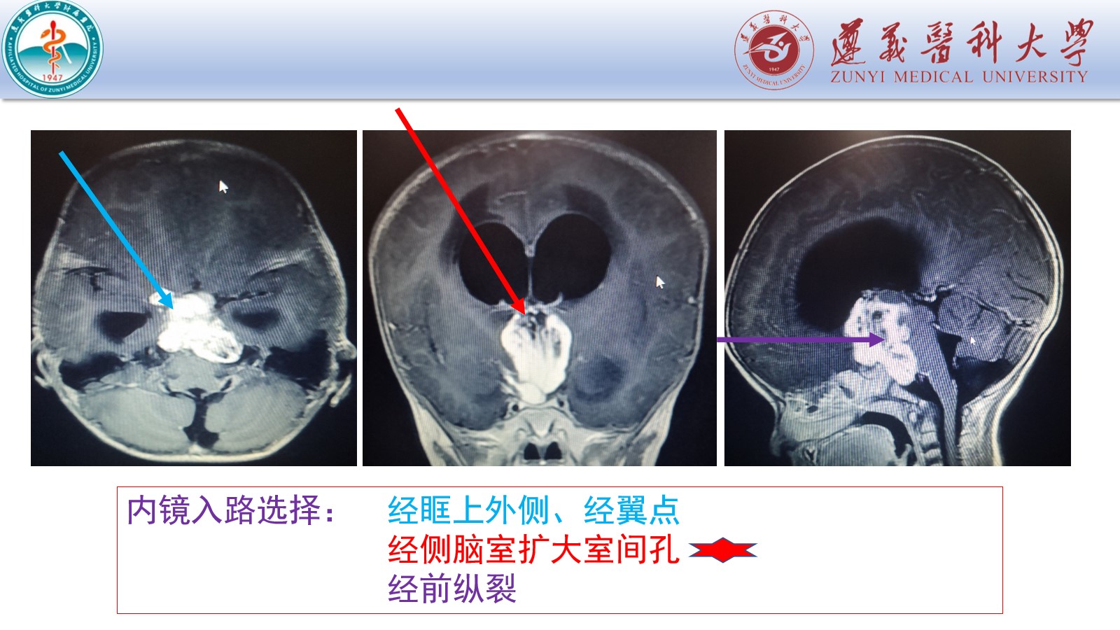 神经内镜经右侧额中回扩大室间孔入路切除幼儿第三脑室脚间池桥前池