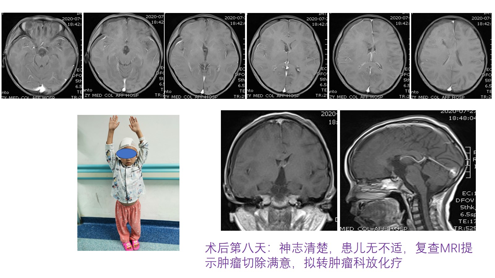 神经内镜经右侧额中回扩大室间孔入路切除幼儿第三脑室,脚间池,桥前池