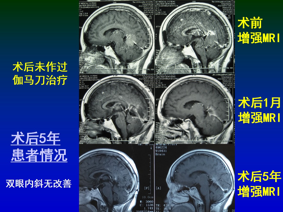 钟东教授团队双镜联合手术治疗松果体区肿瘤