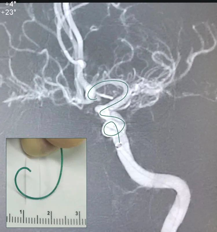 颅内动脉瘤栓塞时弹簧圈的选择第二回微小动脉瘤