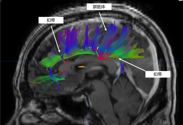 你了解什么是白质纤维吗——神经外科医生眼中的白质解剖之五:扣带