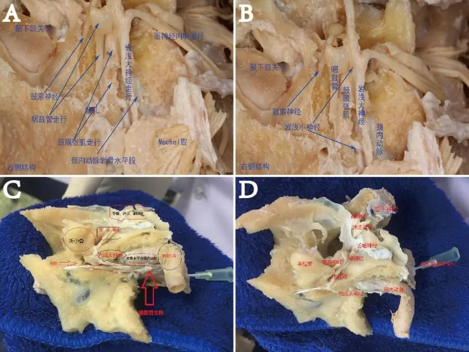 病例分享 正文岩骨前壁外侧相关的重要解剖结构有鼓膜张肌,岩浅小神经