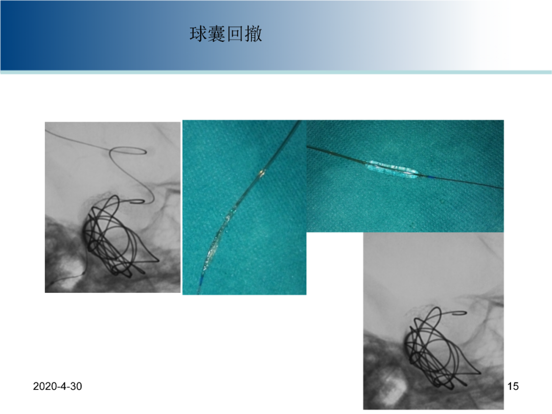 钟书教授专栏丨中枢介入第7期:颅内大型动脉瘤覆膜