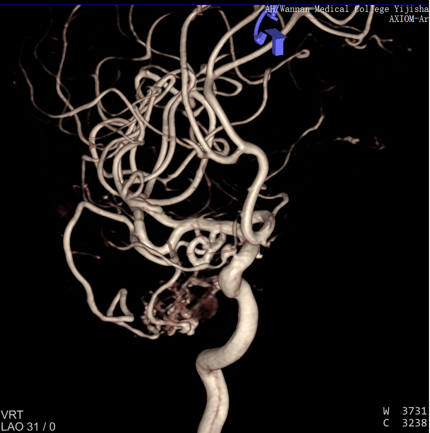 并可见右侧大脑后动脉供血畸形团的分支血管血流相关性动脉瘤两枚