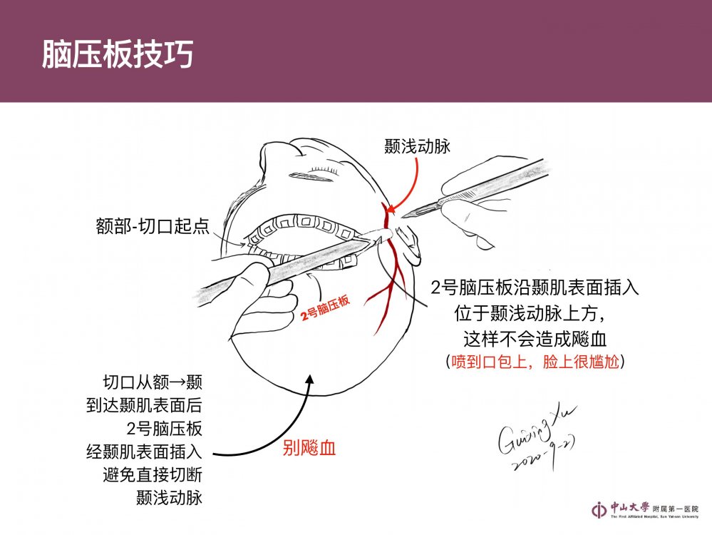 基于"可重复"技能的翼点开颅