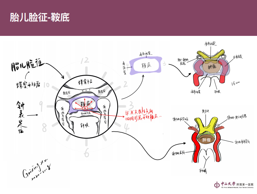 垂体瘤为你提供一些关键点手绘版