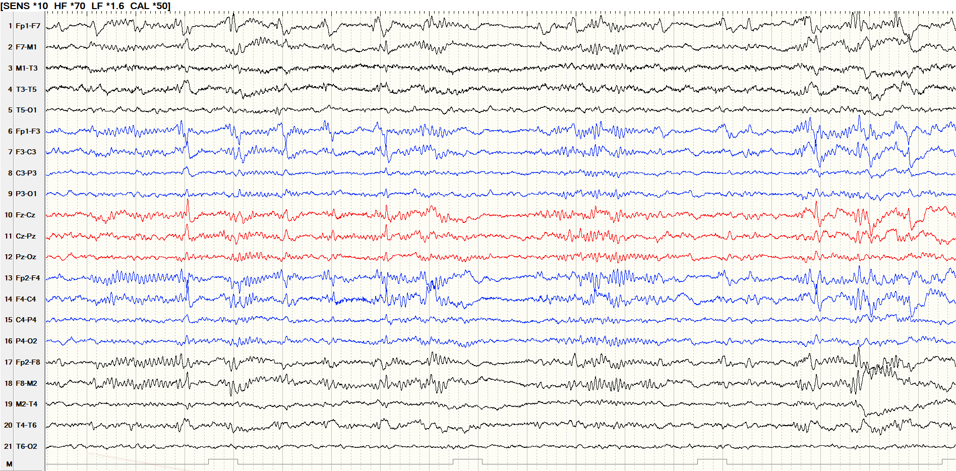 图2.间歇期脑电图,睡眠双前头部近持续棘-慢波,多棘-慢波.