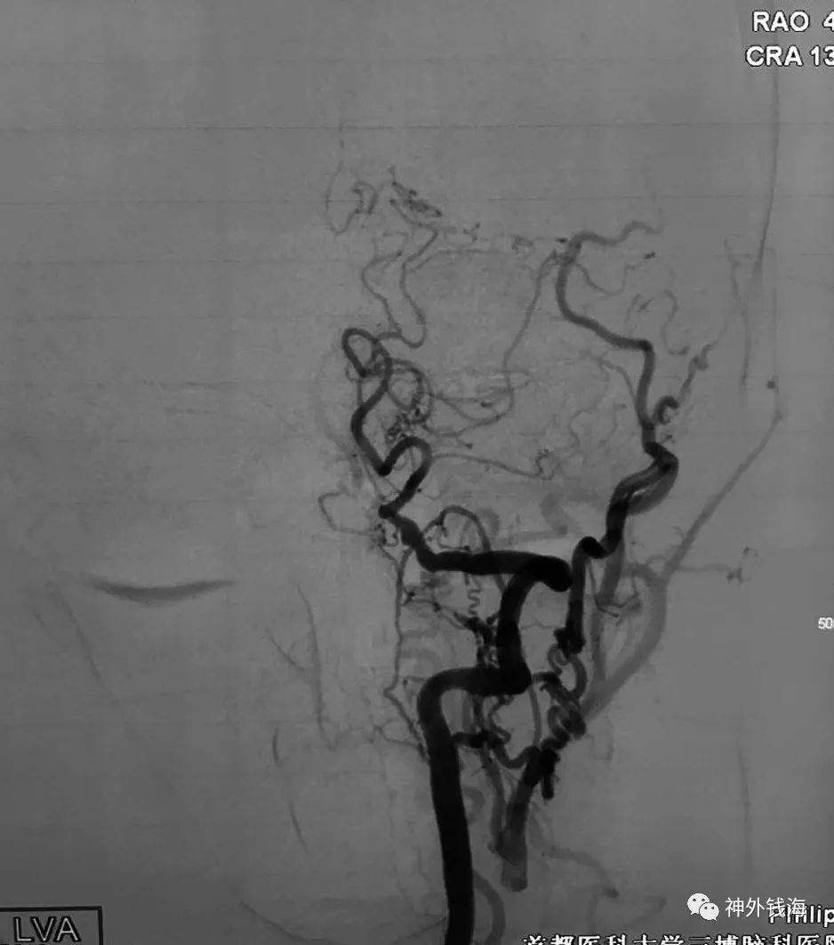 左侧颈动脉造影因为血管已经闭塞