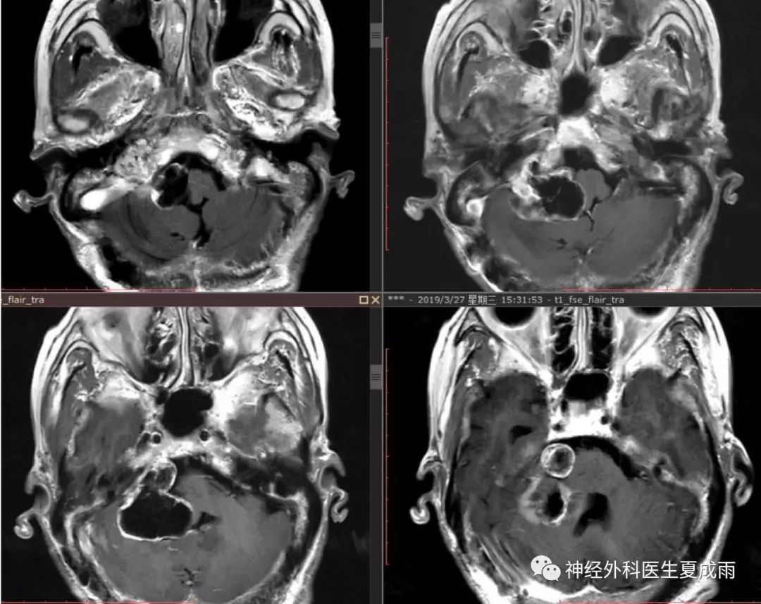 表现类似听神经瘤的神经鞘瘤