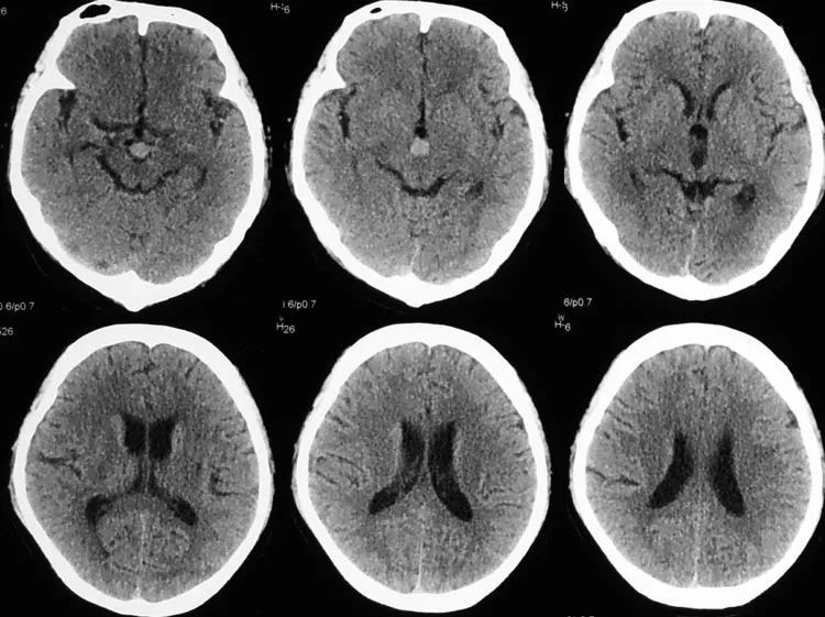 7月22日复查脑ct示sah吸收,脚间池高密度占位