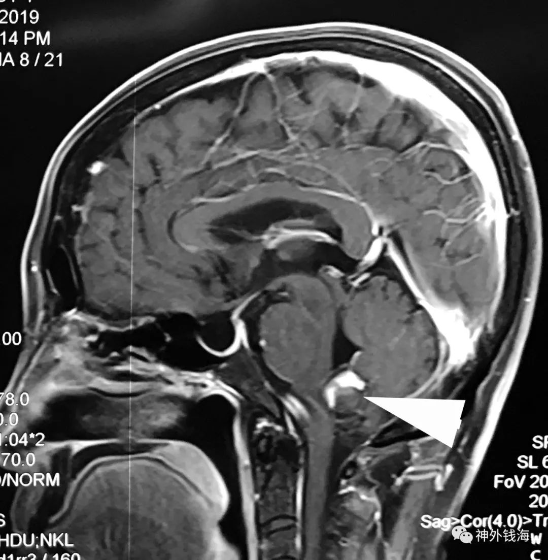 mr可见延髓背侧类圆形占位性病变,有局灶性造影剂聚集.如白箭头所示.